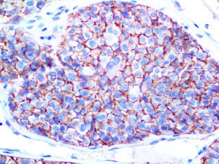 C of Melanoma / KBA.62 on an FFPE Melanoma Tissue